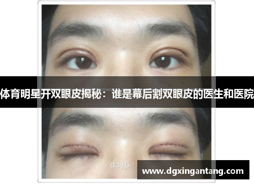 体育明星开双眼皮揭秘：谁是幕后割双眼皮的医生和医院